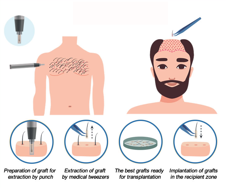 Body To Head Transplant - Shine Hair Clinic